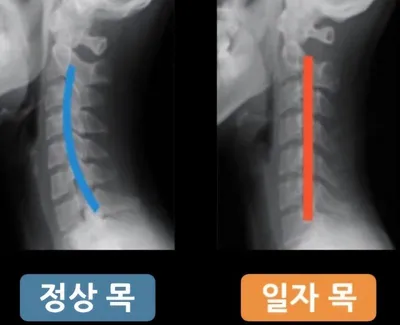 [이청강의 메디컬수첩] 근골격계 질환, 물리치료로 건강 챙기세요